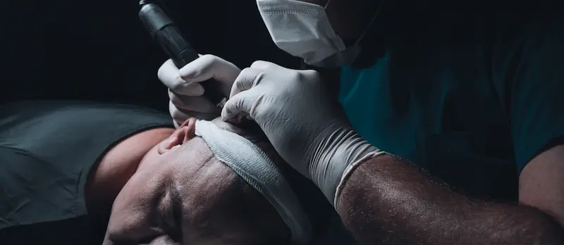 DHI Hair Transplant