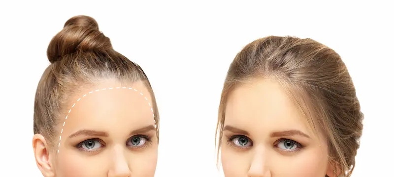 Frontal Fibrosing Alopecia