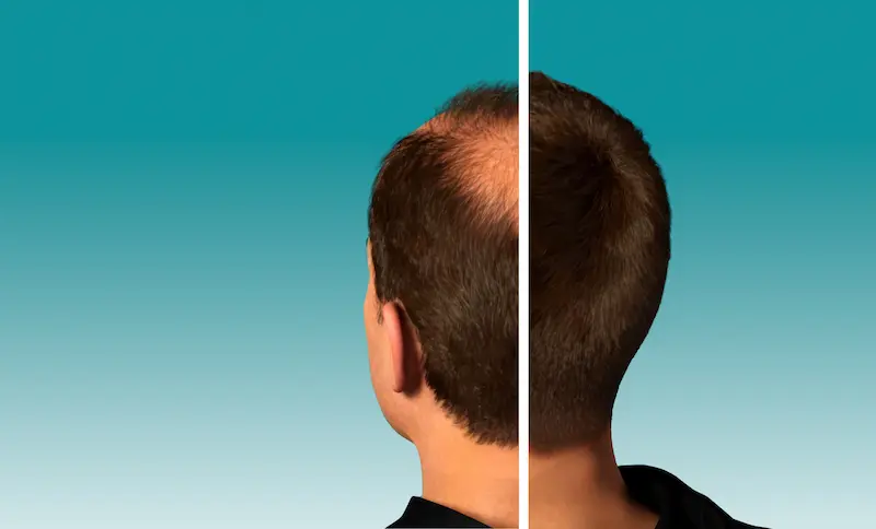 FUE Hair Transplant in Turkey