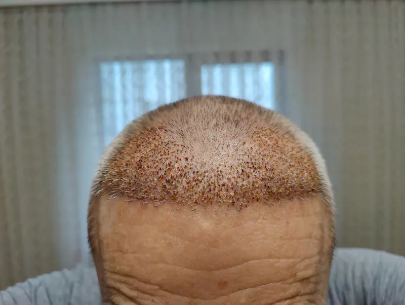 Hair Transplant Healing Progress