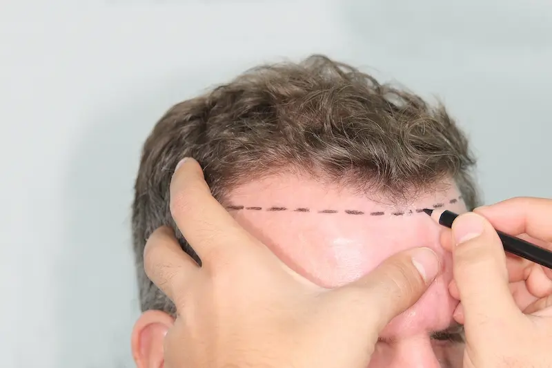 Hair Transplant in Turkey