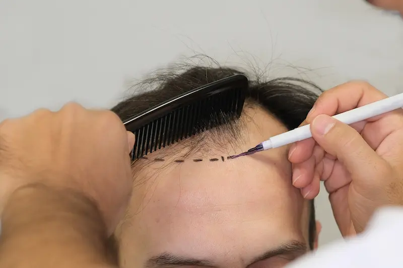 shaving head for hair transplant