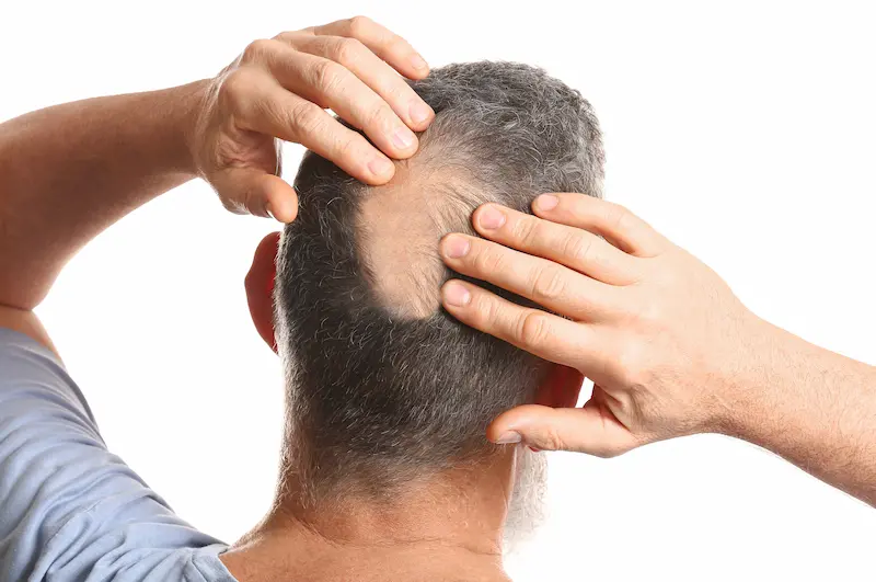 what causes hair loss for men