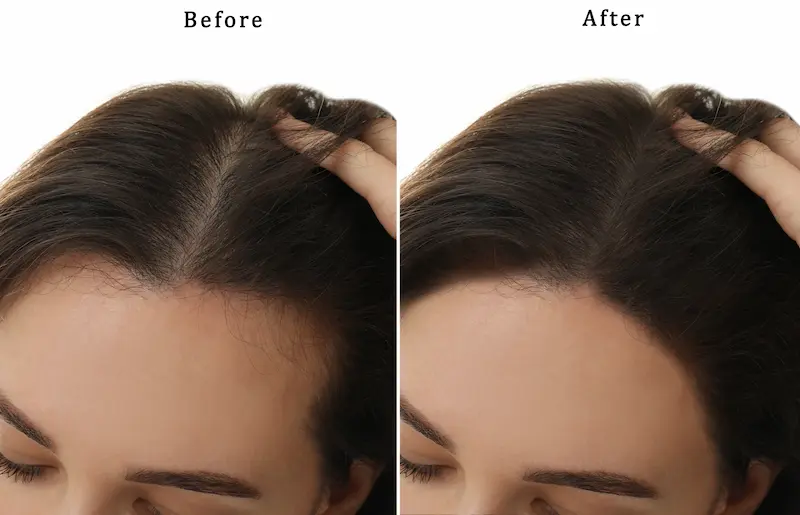 what is finasteride