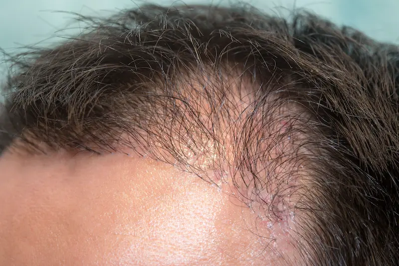 bad hair transplant