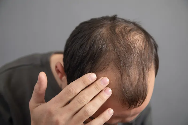 genetic hair loss