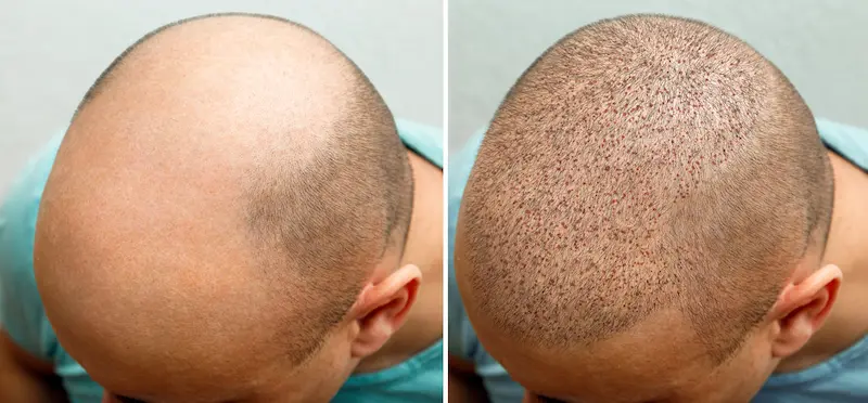 what is hybrid hair transplant